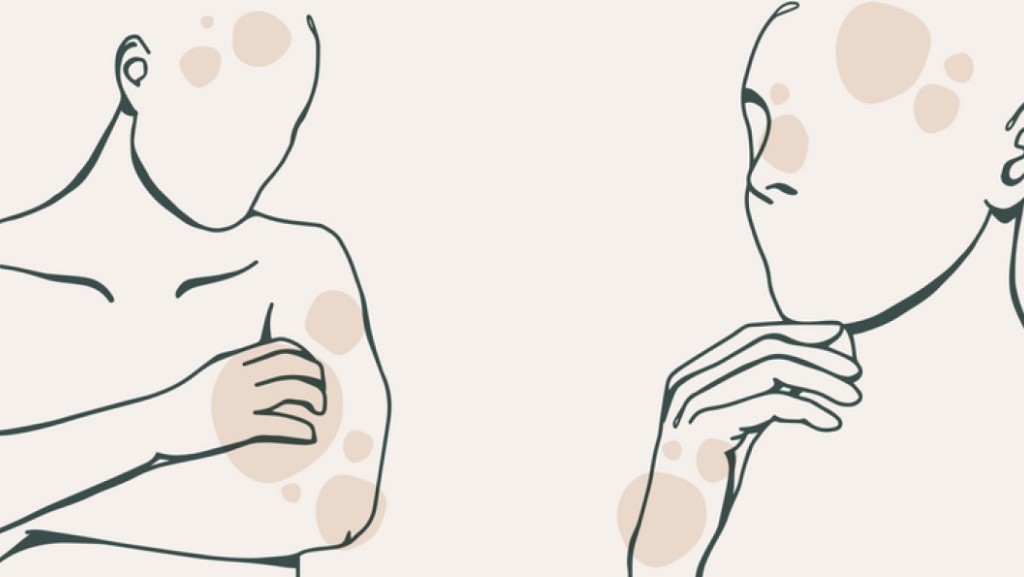 Milien, Warzen, weiche Fibrome und Pigmentflecken - die lästigen Ästhetikmakel der Dermatologie