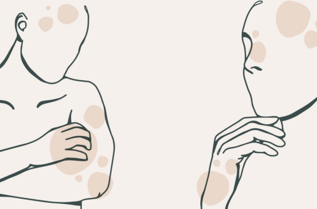 Milien, Warzen, weiche Fibrome und Pigmentflecken - die lästigen Ästhetikmakel der Dermatologie