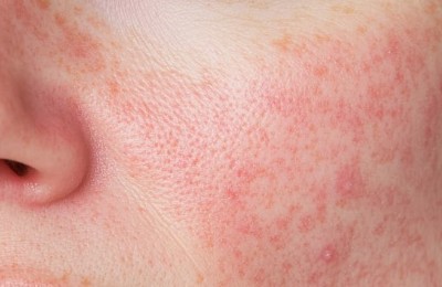 bilder/endlich-gezielte-hilfe-bei-rosacea-foto.jpg