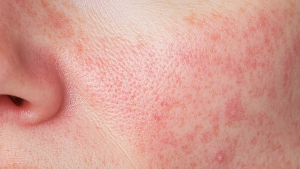Gezielte Hilfe bei Rosacea: Die TRoSA-Skala verbessert die Beurteilung des Schweregrades