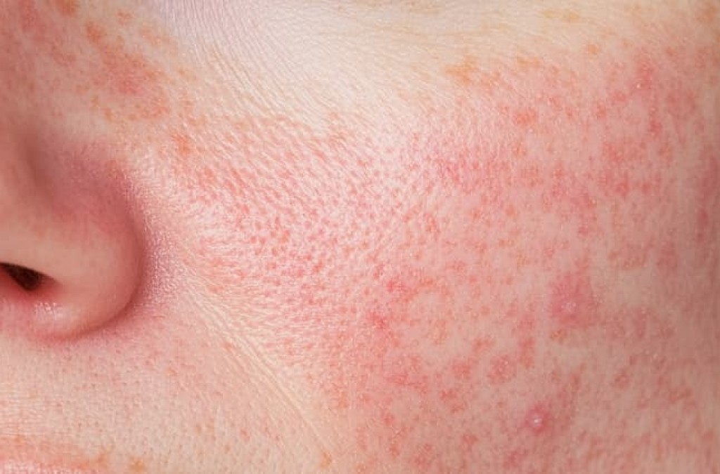 Gezielte Hilfe bei Rosacea: Die TRoSA-Skala verbessert die Beurteilung des Schweregrades