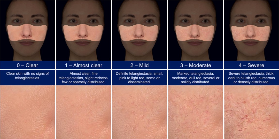 Quelle: Validation of a Photonumeric Scale for Evaluation of Telangiectasia in Rosacea; https://doi.org/10.1111/jocd.16593