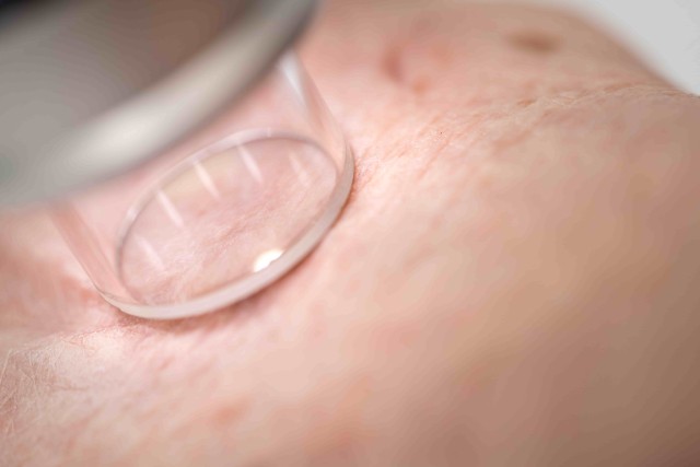 Bei verdächtigen Hautveränderungen umgehend ein Termin beim Dermatologen oder Dermatologin vereinbaren.