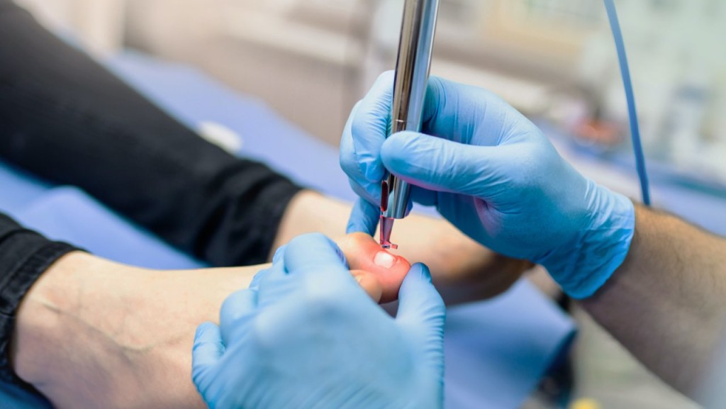 Neue Behandlungsmöglichkeiten gegen Nagelpilz