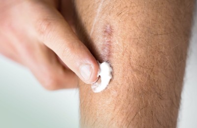 bilder/magazin/narbe-creme.14.jpg