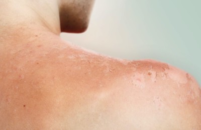 bilder/magazin/sonnenbrand-schulter-rechts.12.jpg