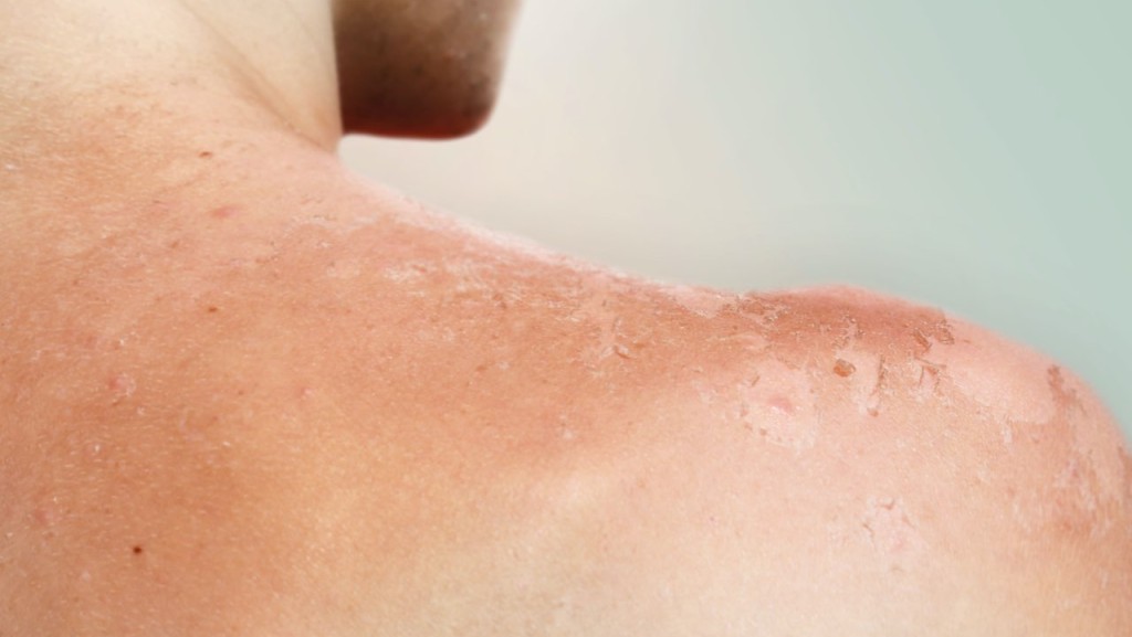 Was passiert bei einem Sonnenbrand?