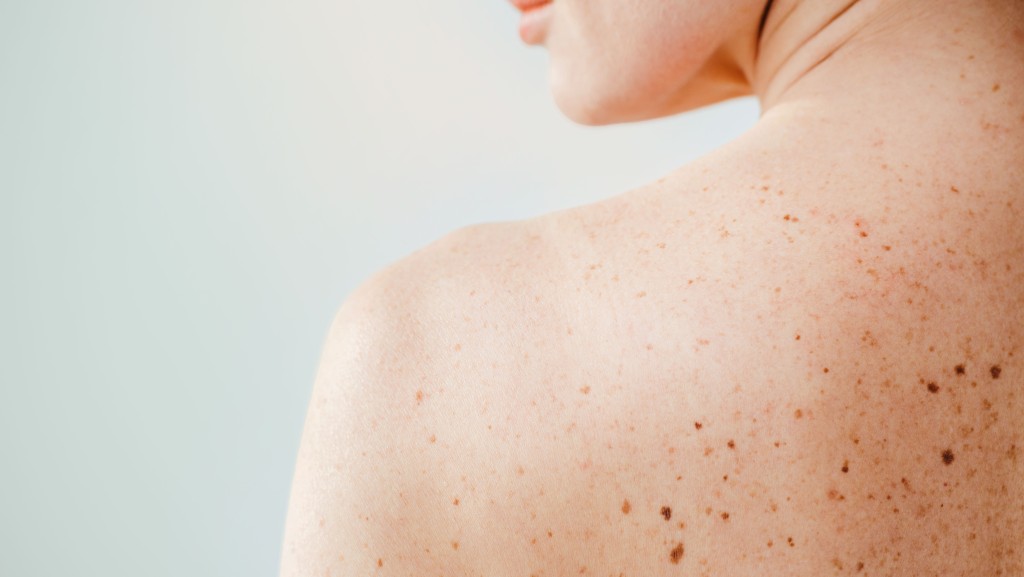Vorsorge ist Fürsorge: Check-up Paket im Dermatologikum