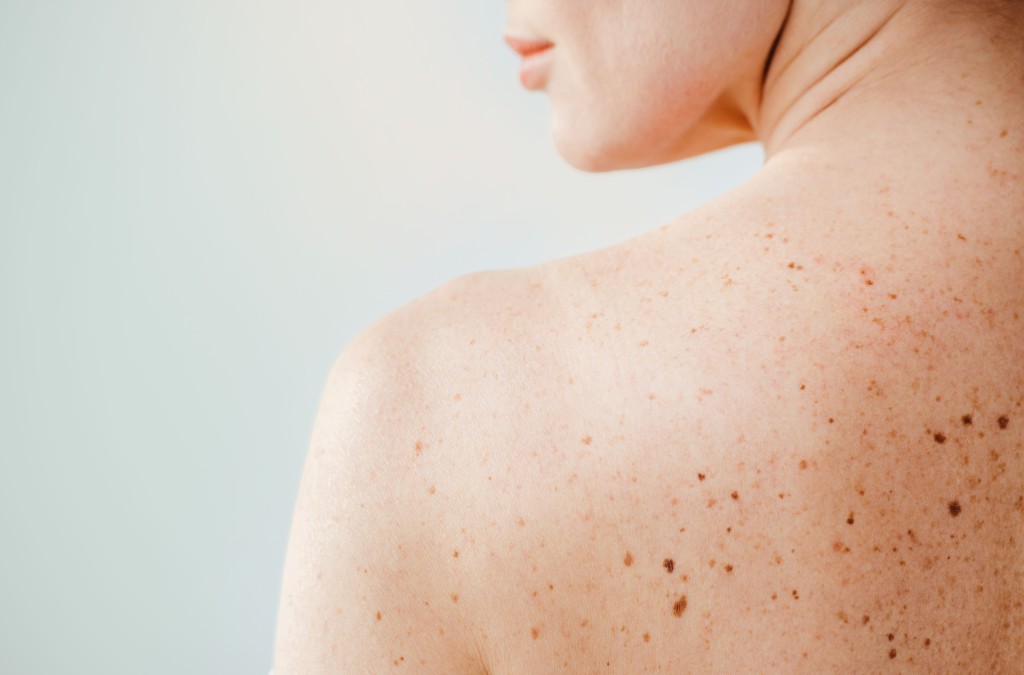 Vorsorge ist Fürsorge: Check-up Paket im Dermatologikum