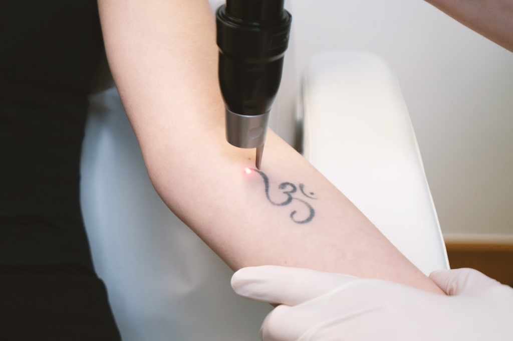 Tattooentfernung mit dem Pikosekunden-Laser
